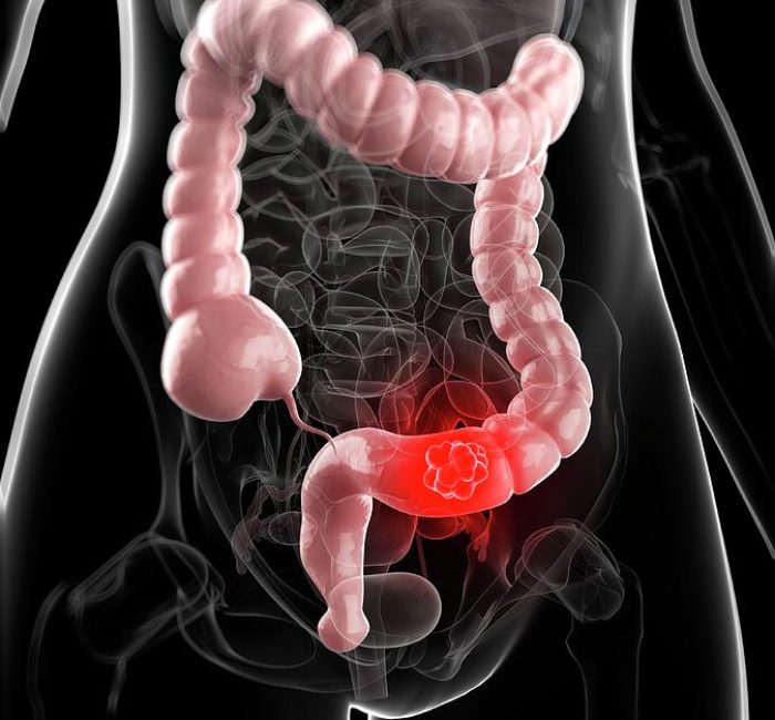 6-colon-cancer-scieproscience-photo-library